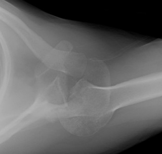 Illustration 2 for Mastering Shoulder & Elbow cases chronic dislocation: A guide