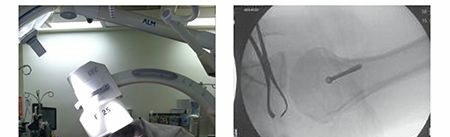 Achieve Precision: When the Intensifier is Brought for Quality Images