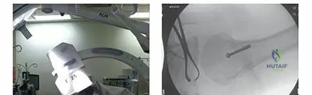 Illustration of intensifier is brought - Dr. Mohammed Hutaif