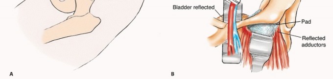 توضيح طبي: جراحة نقائل الحوض: حل شامل لآلام العظام واستعادة الحركة مع الأستاذ الدكتور محمد هطيف