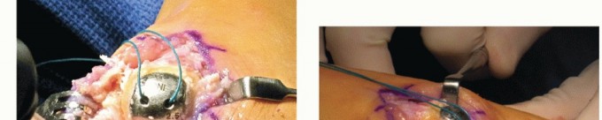 Illustration 39 for End Articular Cartilage Loss: Arthrosurface HemiCAP Resurfacing