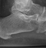 Illustration 14 for Partial Articular Fractureplate Fixation: Restore Anatomy