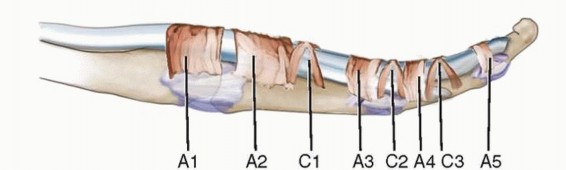 A1 Pulley Release for Trigger Finger with and without Flexor Digitorum Superficialis Ulnar Slip Excision