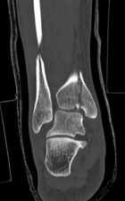 Illustration 5 for Partial Articular Fractureplate Fixation: Restore Anatomy