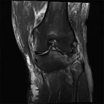 صورة توضيحية لـ كسر هضبة الظنبوب من النوع السادس: دليل شامل للمرضى مع الأستاذ الدكتور محمد هطيف في صنعاء
