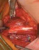 Operative Management of the Adducted Thumb and Intrinsic Hand Contractures