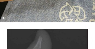 Illustration 4 for Orthopedic Hand Cases: A Patient's Journey, Is a Year Old a Factor?