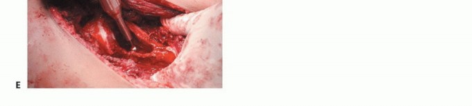 توضيح طبي: جراحة نقائل الحوض: حل شامل لآلام العظام واستعادة الحركة مع الأستاذ الدكتور محمد هطيف