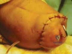 Adult Hip Reconstruction & Arthroplasty MCQs | Ortho Board