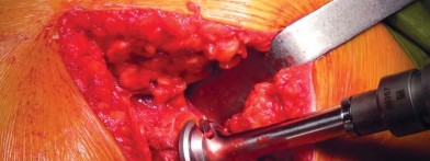 صورة طبية: تقنية الجذع القصير لاستبدال مفصل الورك الكلي: نهج الأستاذ الدكتور محمد هطيف لتدخل جراحي أقل ونتائج أفضل