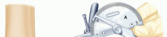 Elbow Arthrodesis: Optimizing Outcomes in a Difficult Elbow Fusion