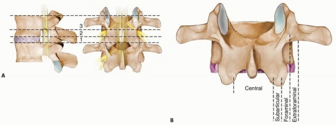 Lumbar Discectomy: Relieve Your Lumbar Disc Herniation Pain