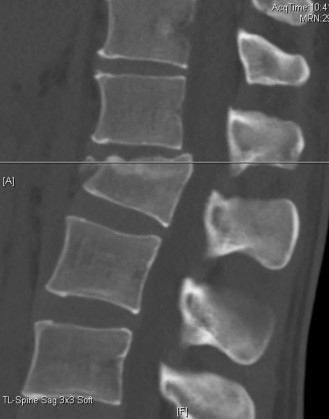 Illustration 9 for Adjacent Segment Degeneration: Your Next Spine Case Solved