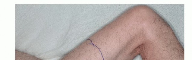 صورة طبية: استئصال ساركوما العضلة الرباعية مع الحفاظ على الطرف: دليل شامل للمرضى مع الأستاذ الدكتور محمد هطيف في صنعاء