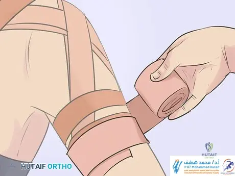 وداعاً لخلع الكتف المتكرر: فهم وعلاج عدم استقرار الكتف