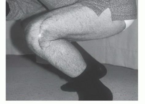 صورة طبية: تجنب الجراحة الكبرى: علاج أورام العظام بالنيتروجين السائل بتقنية الصب المباشر