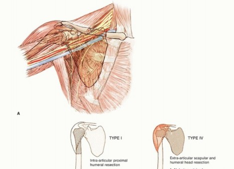 Mastering Proximal Humerus Resection: Limb-Sparing Techniques
