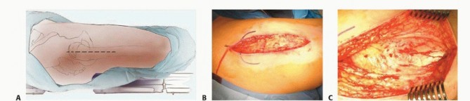 Illustration 7 for Proximal Femoral Osteotomy: When This Hip-Saving Surgery Is Performed