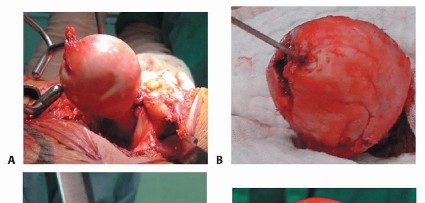 صورة طبية: ترميم مفصل الورك: الحل الأمثل للحفاظ على عظم رأس الفخذ في صنعاء مع الدكتور محمد هطيف