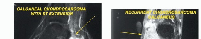 صورة توضيحية لـ أورام القدم: دليلك الشامل للعلاج، البتر، والاستئصال مع الأستاذ الدكتور محمد هطيف في صنعاء