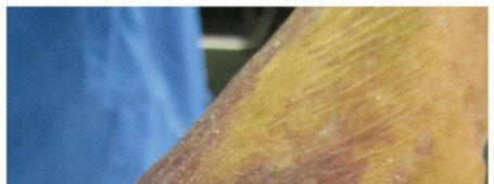 Distal Humeral Fractures: When Is Elbow Replacement the Best Option?