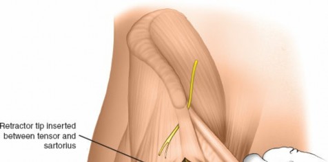 Illustration 24 for Expert Guide: Ulna and Wrist External Fixation Pin Placement