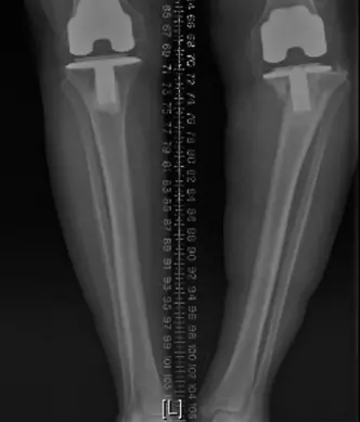 صورة توضيحية لـ ألم مفصل الركبة الصناعي: دليل شامل لتشخيص وعلاج التهاب وارتخاء المفصل الصناعي