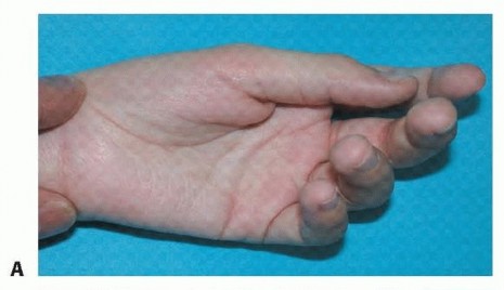 Correction of Thumb-in-Palm Deformity in Cerebral Palsy
