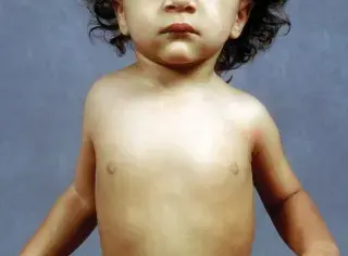 تشوه سبرينغل: دليل شامل للمرضى والعائلات في اليمن والخليج العربي مع الأستاذ الدكتور محمد هطيف