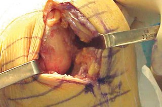 Illustration 27 for Knee Arthroplasty: Avoiding Pitfalls & Benefiting from UKA