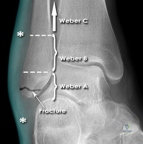 Illustration of ankle fractures dislocations - Dr. Mohammed Hutaif