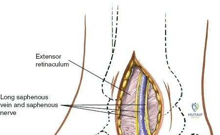 Illustration of approaches to the medial - Dr. Mohammed Hutaif