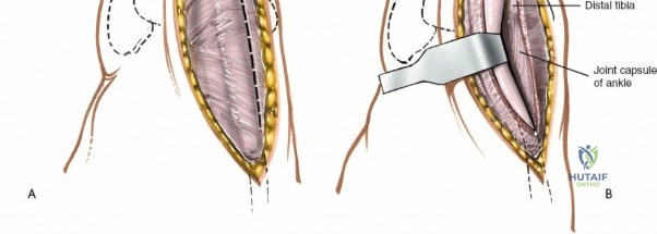 Illustration of ankle anterior approach - Dr. Mohammed Hutaif