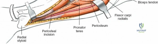 Radius Anterior Approach: Safe Nerve Protection & Complete Exposure