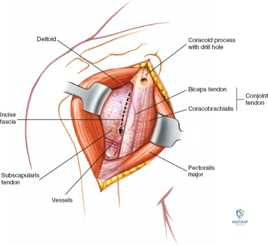 -4 Position of the patient for the anterior approach to the shoulder. Elevate the table to 45 degrees. A sandbag placed under the spine at the medial end of the scapula will allow the shoulder to rotate externally and open the anterior part of the joint.