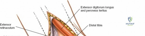 Illustration of ankle and hindpart - Dr. Mohammed Hutaif