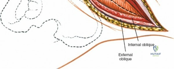 Illustration of anterolateral retroperitoneal approach - Dr. Mohammed Hutaif