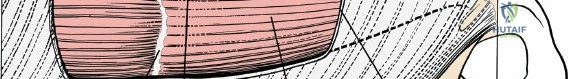 Illustration of rectus abdominis muscle - Dr. Mohammed Hutaif