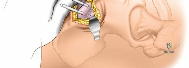 Illustration of external fixation pelvisfemurtibia - Dr. Mohammed Hutaif