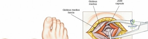 Illustration of lateral intermuscular septum - Dr. Mohammed Hutaif