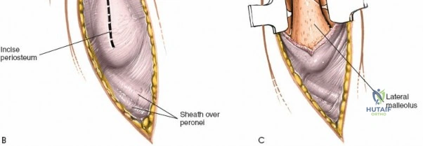 Optimized Approaches to the Dorsum of the Foot & Ankle