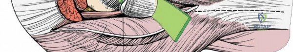 Illustration of aspect of the hip - Dr. Mohammed Hutaif