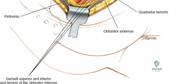 Illustration of posterior superior iliac - Dr. Mohammed Hutaif
