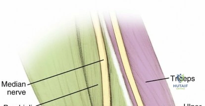 Illustration of miller md et - Dr. Mohammed Hutaif