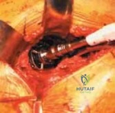 Arthrodesis of the First Metatarsocuneiform Articulation (Lapidus Procedure) and Management of Adolescent Hallux Valgus