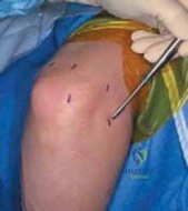 Illustration of elbow degenerative joint disease - Dr. Mohammed Hutaif