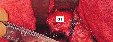 Illustration 8 for Mastering Soft Tissue Balancing for Optimal THR Outcomes