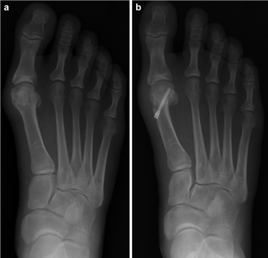 Illustration 64 for First Metatarsal Surgery: Expert Solutions for Foot & Ankle Pain