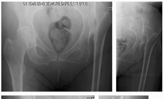 صورة توضيحية لـ إعادة بناء مفصل الورك المعقد لخلع الورك التنموي (DDH) باستخدام ترقيع رأس الفخذ الذاتي في صنعاء