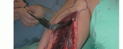 صورة طبية: ترقيع الشظية الوعائي الحر: حلول متقدمة لعيوب العظام المعقدة